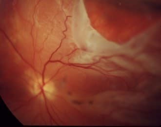 Desprendimiento de Retina 