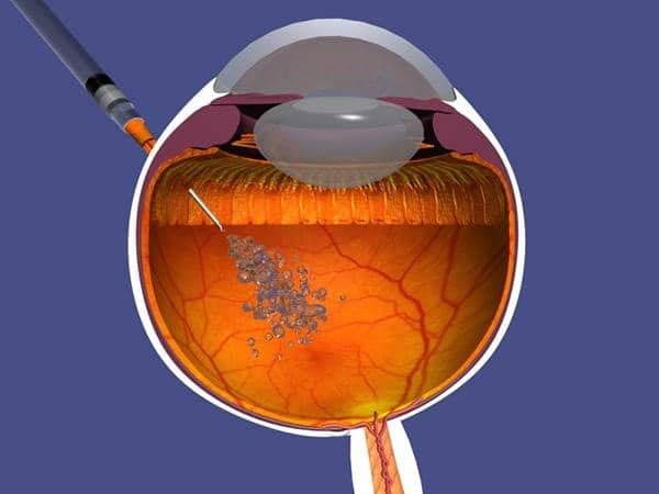 inyeccion_intravitrea_1