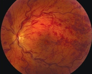 Obstrucción Vascular de la Retina