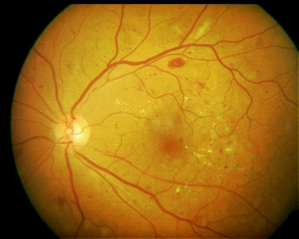 Retinopatía Diabética